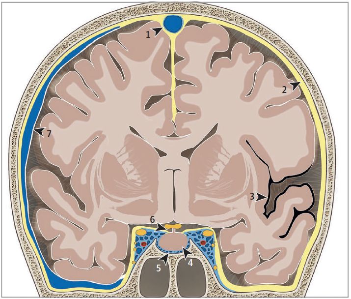 jaman容易忽视的低颅压mri征象