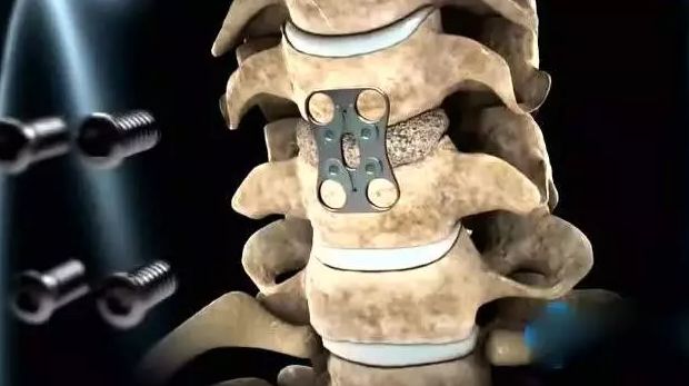 伤筋动骨100天,骨折后这样吃才是"以形补形"05-23特稿免费咨询点击"