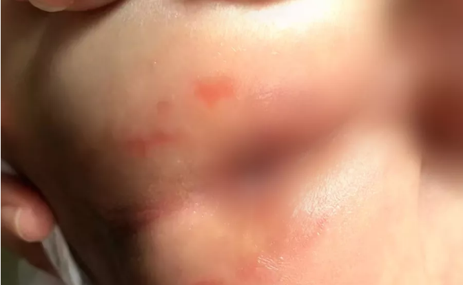 宝宝红屁屁在医学上被称作"尿布疹",便便和尿液的刺激,臀部皮肤长时间