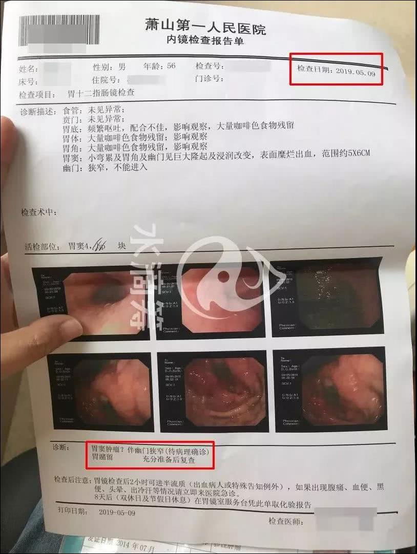 胃癌早期报告单图片图片