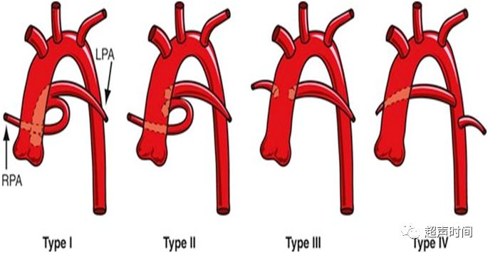 钰您谈心胎儿永存动脉干畸形
