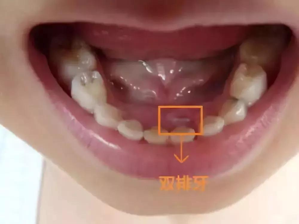 第二双尖牙换吗图片