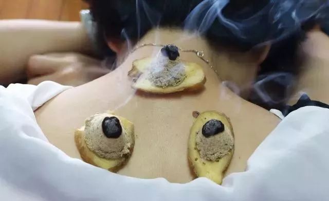 养生三伏贴三伏灸冬病夏治到底有效吗