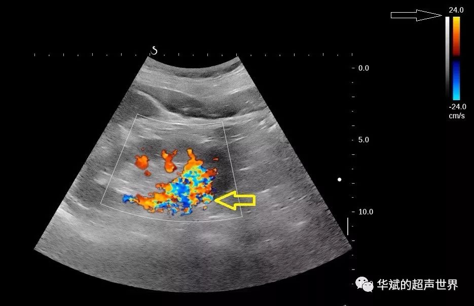 左肾静脉超声图片图片