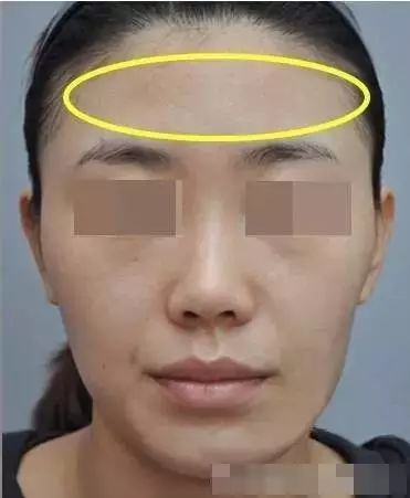 甚至凹陷状缺乏亲和力还会呈现过度削瘦的面相那种婴儿肥般的少女感就