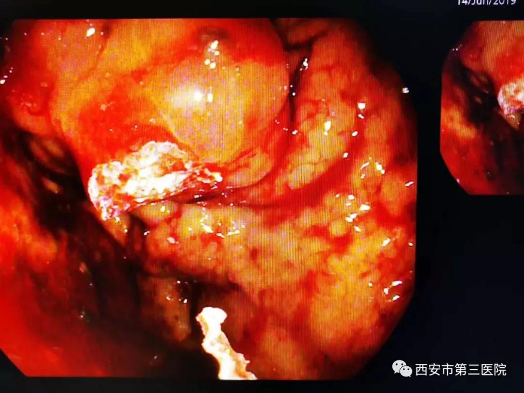 上消化道出血胃镜图片图片