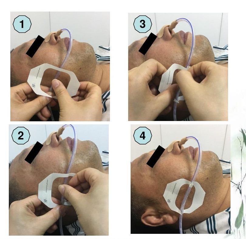 胃管固定改良小窍门看看湘雅二医院怎么做