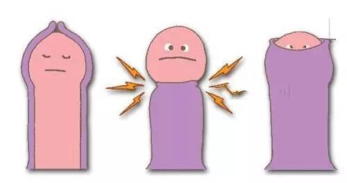 包茎是指包皮口狭小,龟头被包皮完整包住,包皮不能翻转显露龟头.