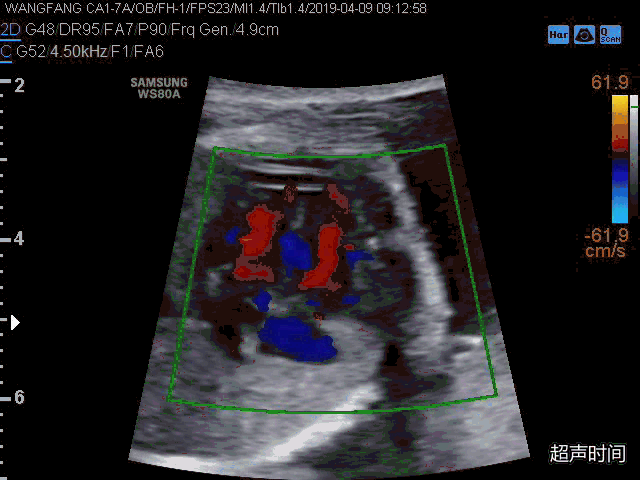 lpa:左肺动脉下列图像和视频所示为一例经产前心脏超声发现的孕 23 周