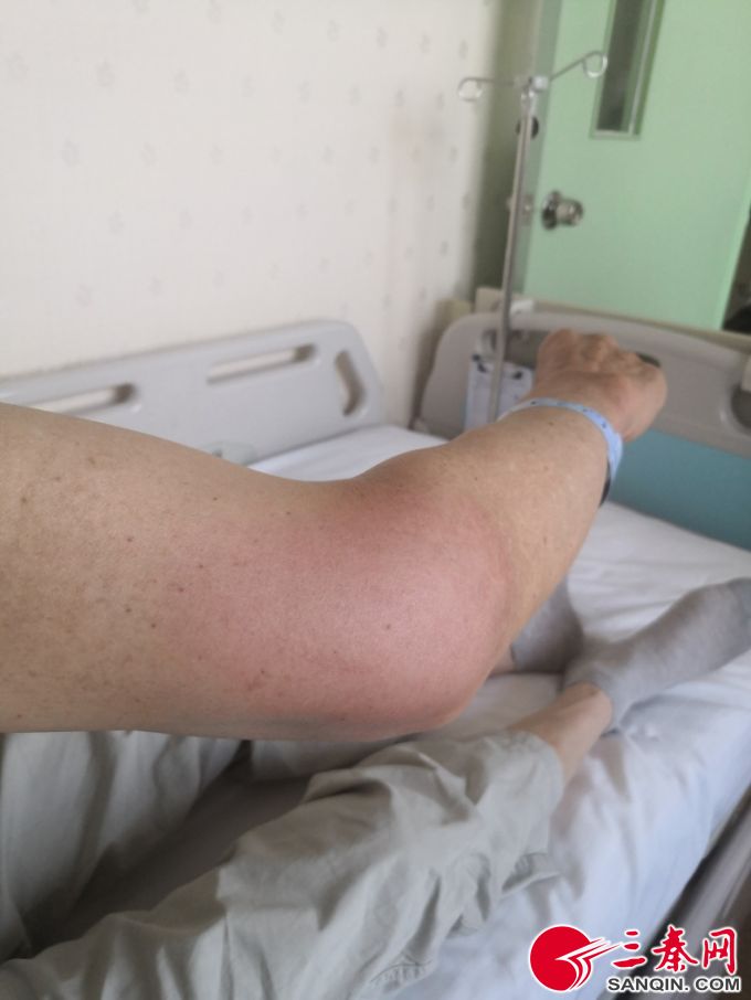 肠胃病也能导致风湿病男子一觉睡醒胳膊肘伸不直