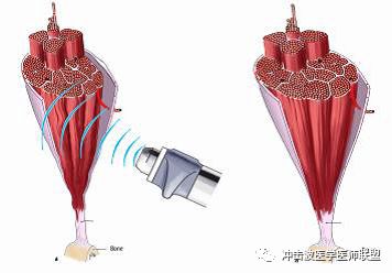 eswt体外冲击波图片