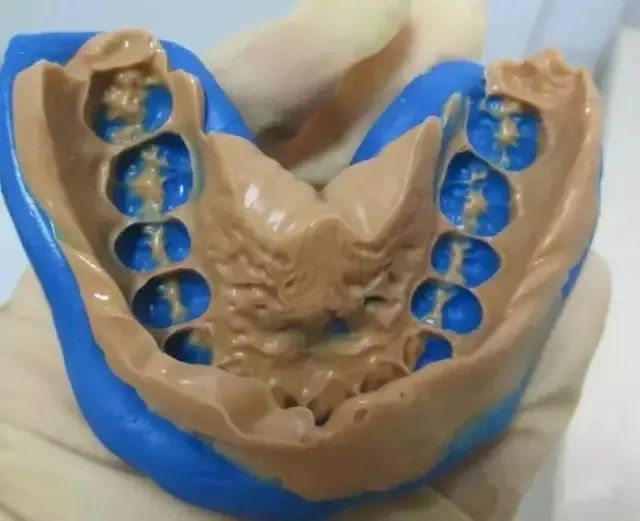 硅橡胶印模缺陷临床检查10大要素