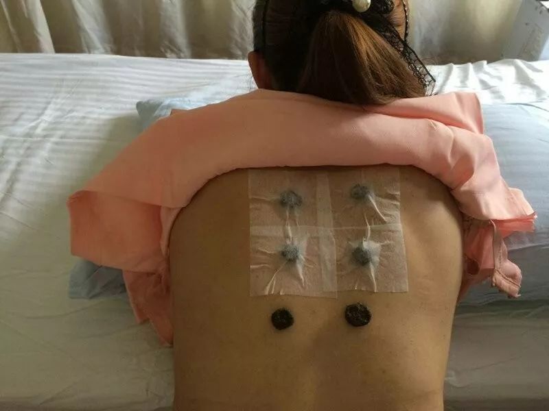 三伏灸的注意事项:1.贴药前应先洗澡或清洗贴敷部位;2.