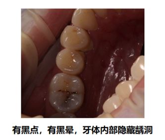 第一种可能是龋齿,蛀牙从外面看表现为黑点,但往往里面有一个挺大的龋