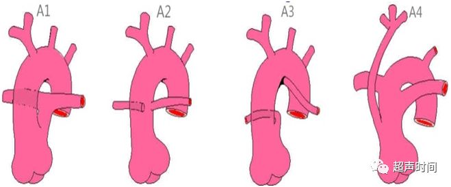 共同动脉干分型图片图片