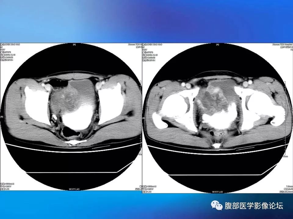 膀胱炎性肌纖維母細胞瘤(交界性)