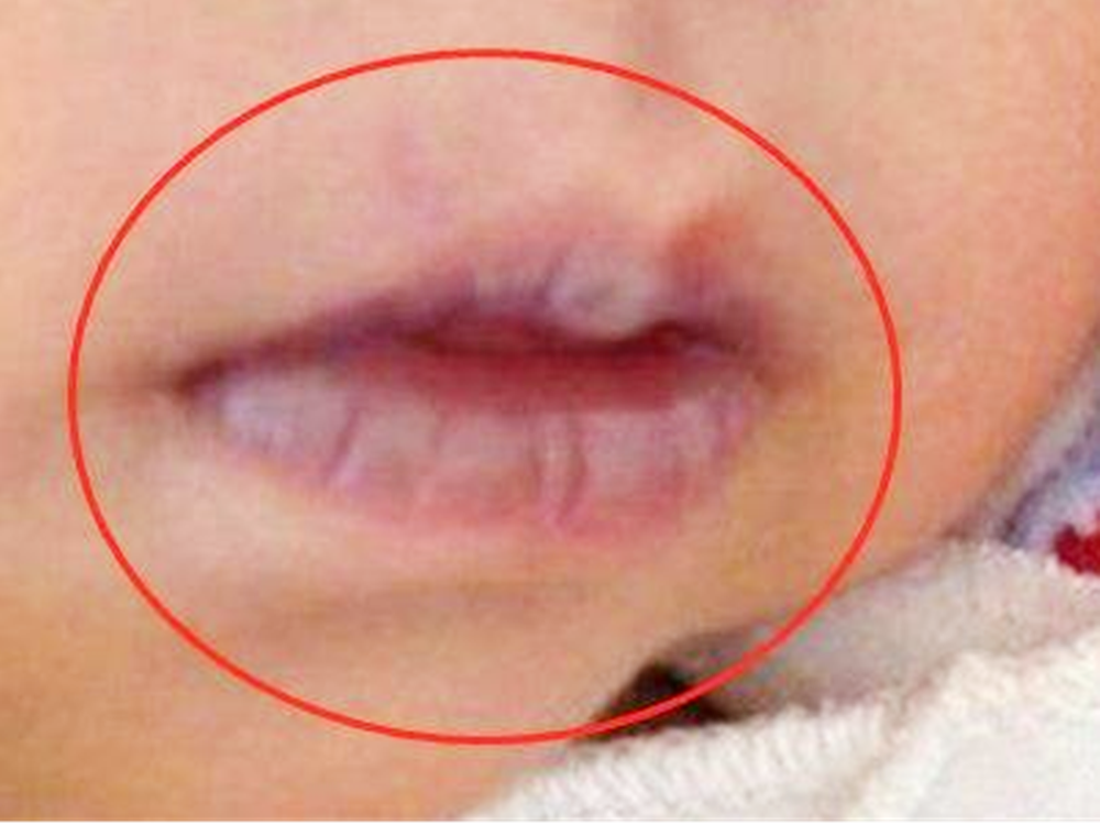 且伴随口唇青紫等现象,不要误以为是可爱,很可能是得了新生儿肺炎