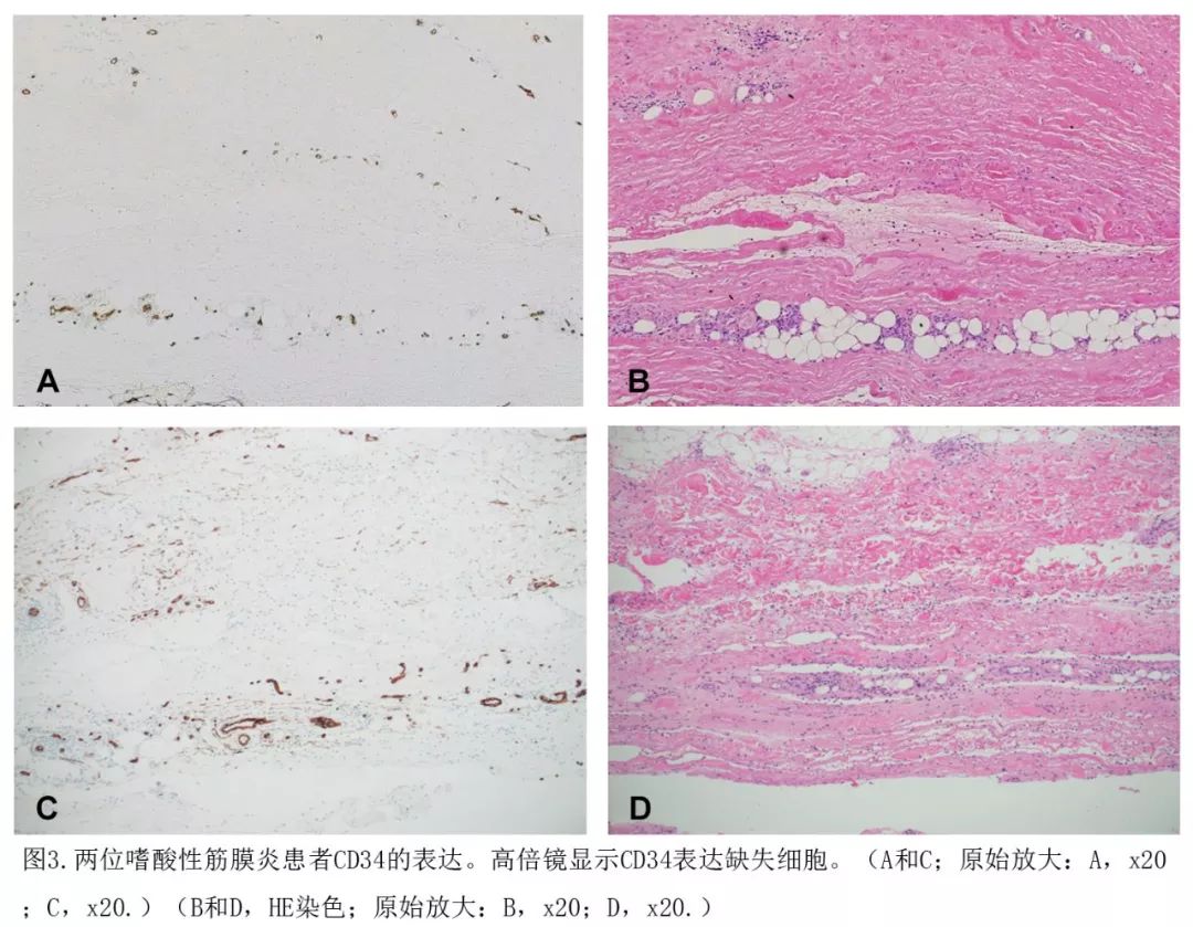 嗜酸性筋膜炎和深部硬斑病的临床病理和免疫表型特征一项27例的比较