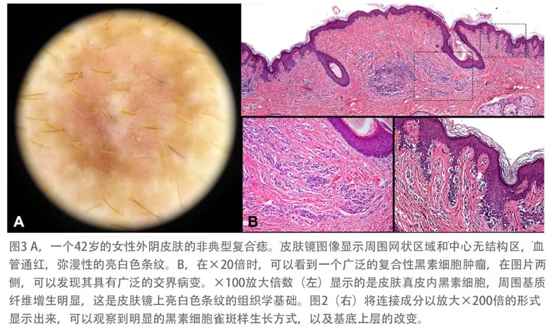 女儿得了spitz痣切除了图片