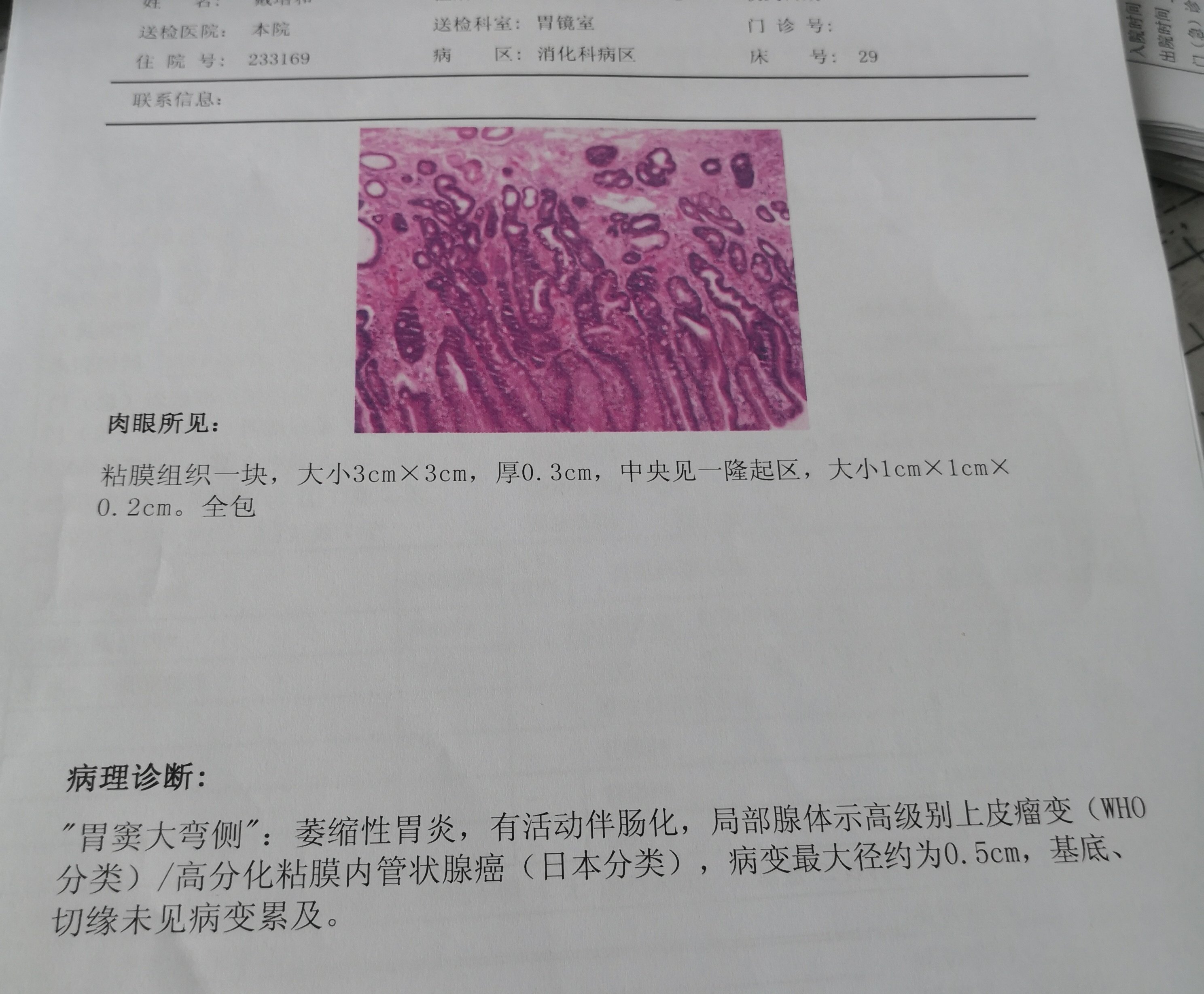 显而易见这是典型的萎缩性胃炎癌变.