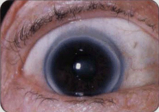 4,黑眼珠有环(角膜老年环)眼角膜周围出现一圈灰白色的环,称为角膜