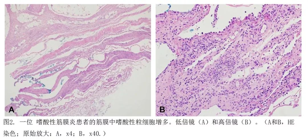 嗜酸性筋膜炎和深部硬斑病的临床病理和免疫表型特征一项27例的比较