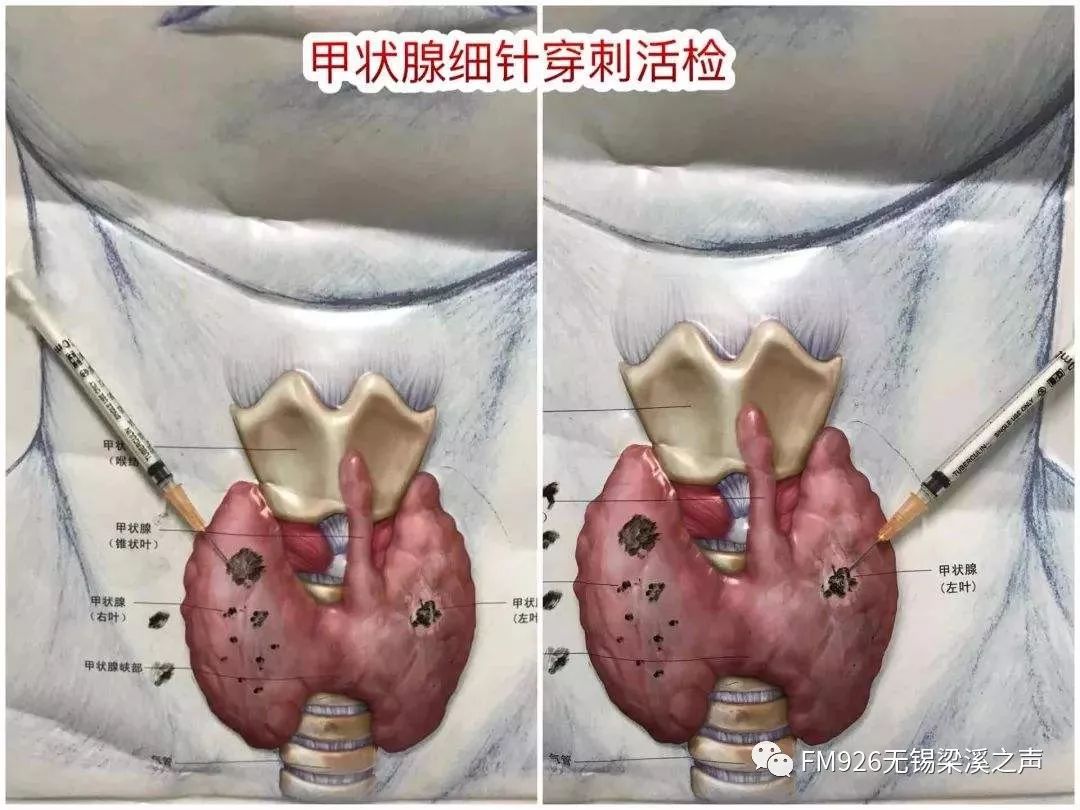 明天上午健康无锡移动直播甲状腺细针穿刺操作