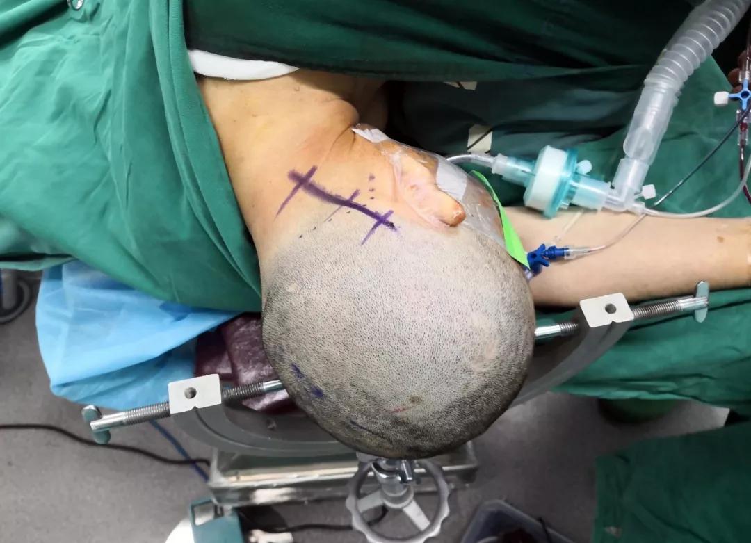 一流技术巨大听神经瘤九江市中医医院独立完成显微镜下手术全切