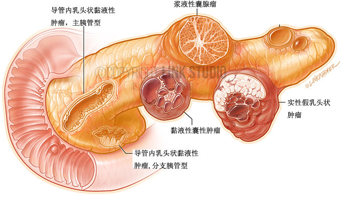 胰腺囊肿并非全是肿瘤,要分清什么情况应该定期复查