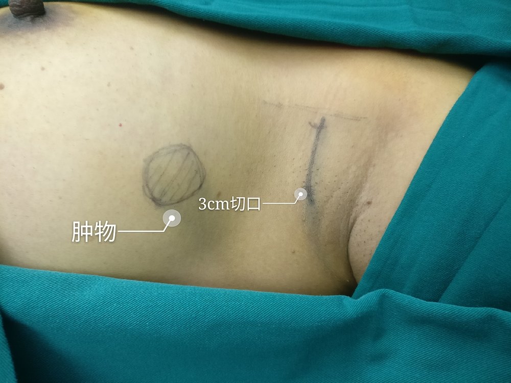 乳腺癌手术切口示意图图片