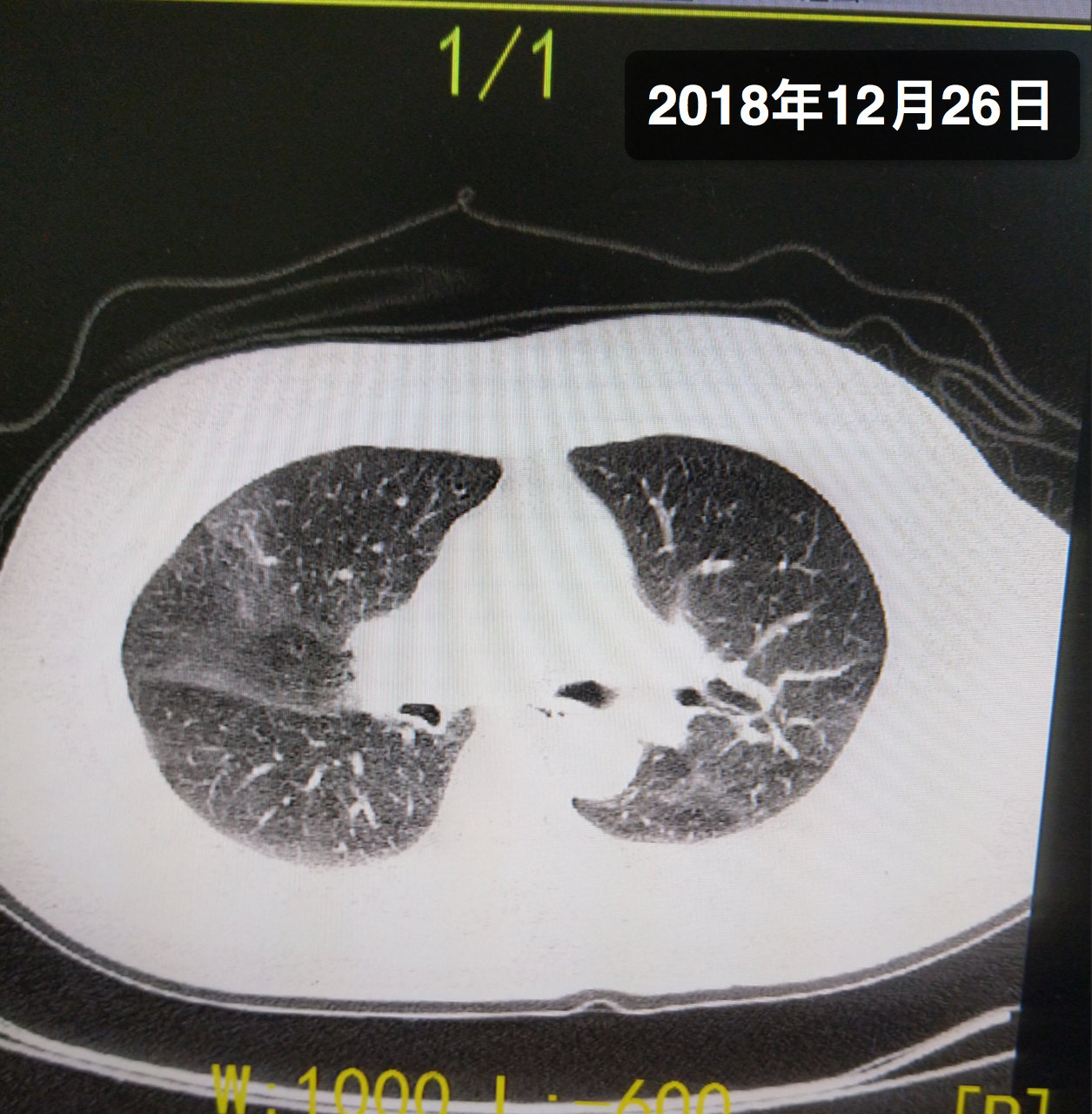 间质性肺炎ct图片特点图片