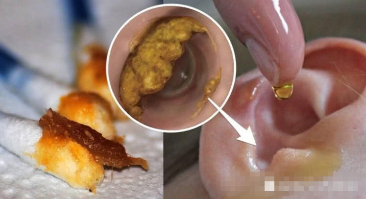 为什么有的人"耳屎"是湿的,有的人却很干?意味着什么?_耳朵