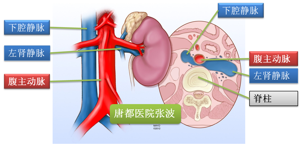 女性左肾静脉胡桃夹图片