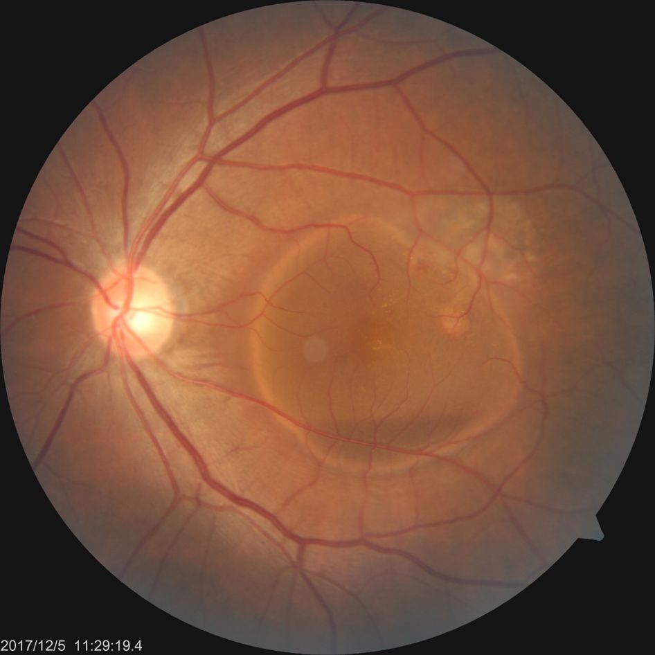 每周最佳病例分享octa扫雷记