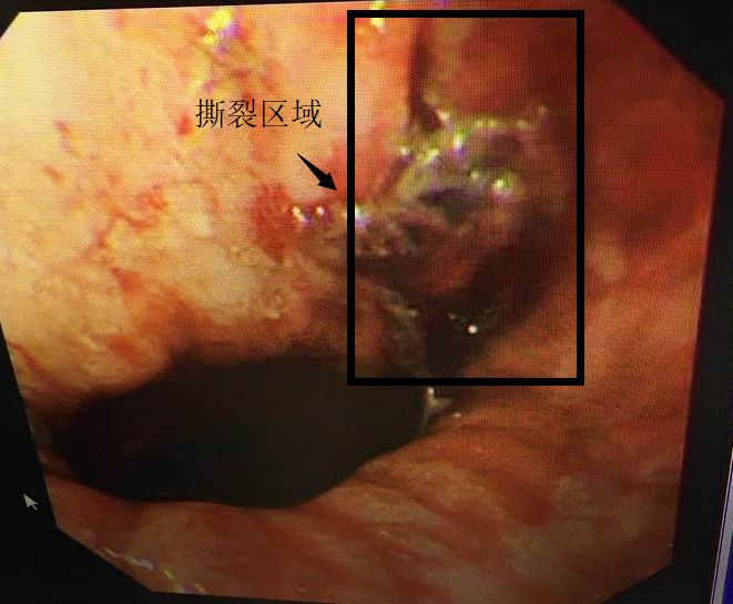 衛生資訊鉛衣戰士與賁門撕裂的生死競速