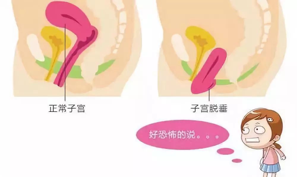 恩爱夫妻的冷血杀手——盆底功能障碍性疾病!