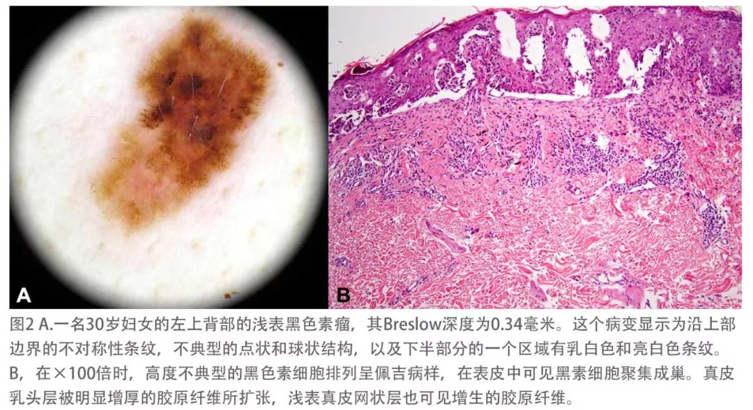 恶性黑色素瘤卫星灶图片