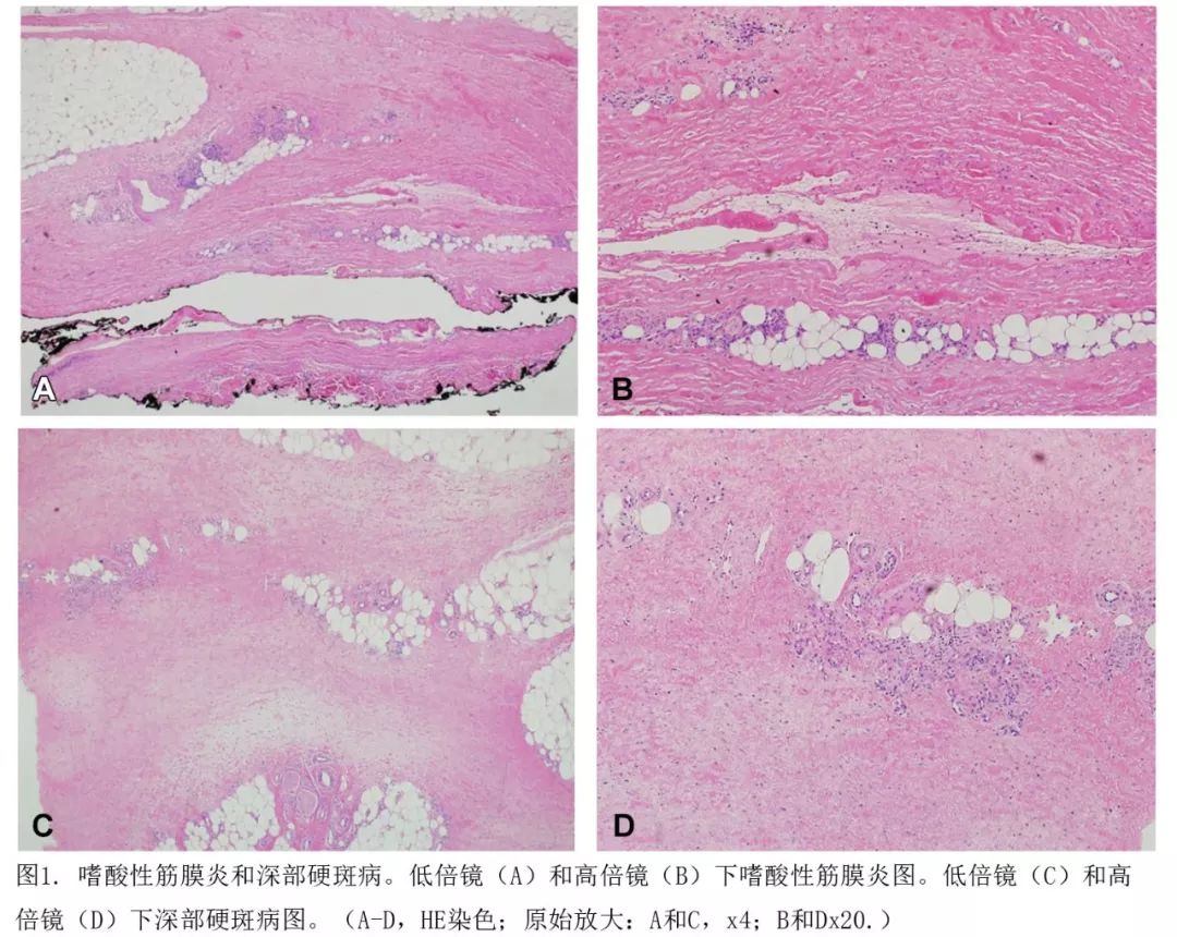 嗜酸性筋膜炎和深部硬斑病的临床病理和免疫表型特征一项27例的比较