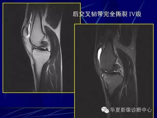 膝關節損傷mri診斷