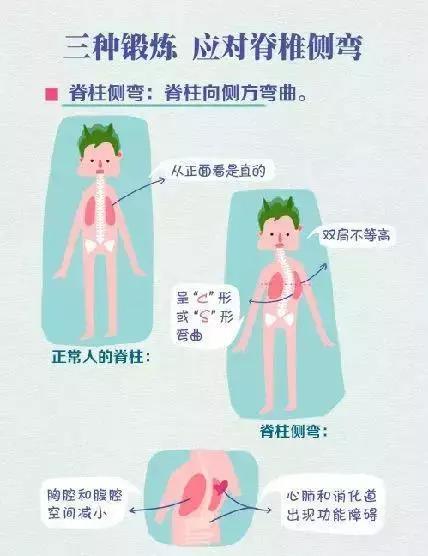 三種鍛鍊應對脊柱側彎——脊柱側彎專家王宇科普系列_spine