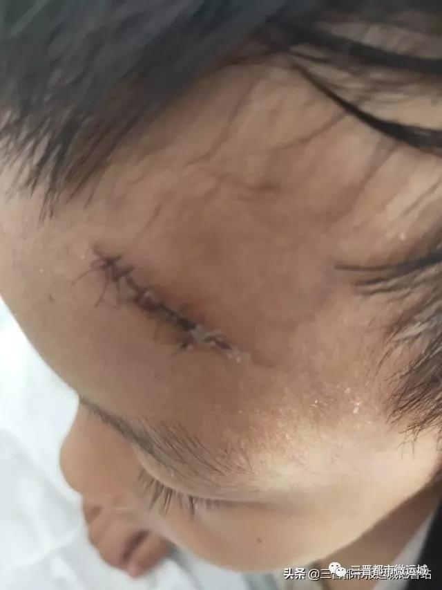 运城3岁小孩在校摔伤老师说辞不一校方称监控坏了