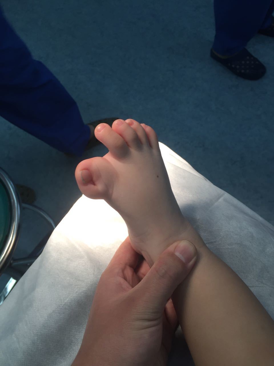 足拇指内翻畸形,一次手术矫正 (原创)