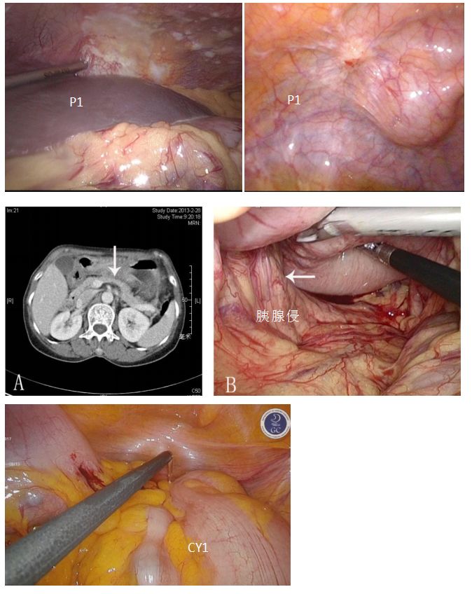 王亚农教授腹腔镜分期在选择Ⅳ期胃癌转化治疗中的意义