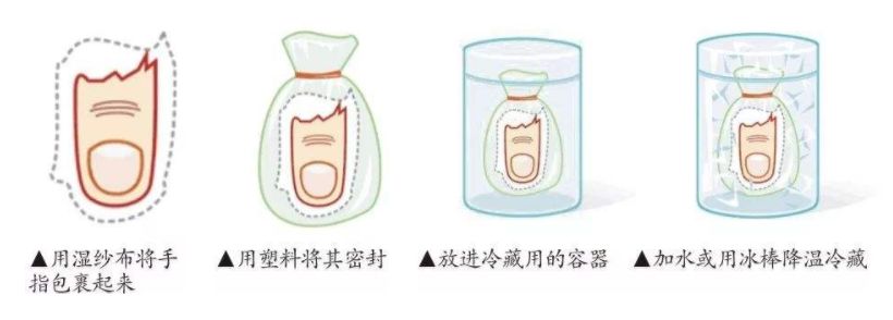 一时大意左手四指瞬间离断医生提醒夏季易疲劳操作失误多务必注意安全