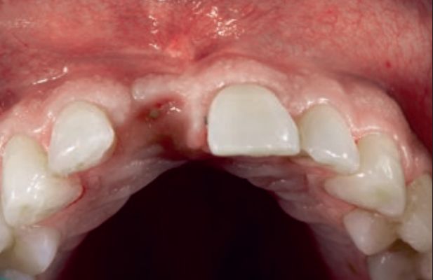 改良龈瓣设计结合pla膜及βtcp骨替代材料行美学区水平骨增量的疗效