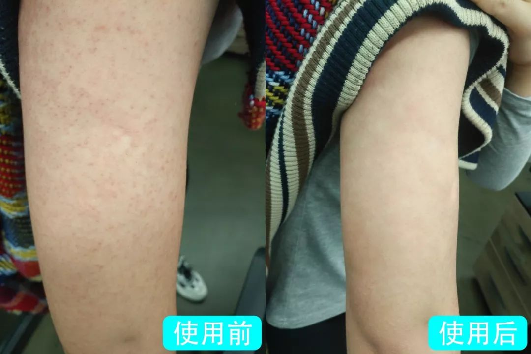 身上起鸡皮疙瘩却流汗(出汗过多皮肤出现鸡皮疙瘩)