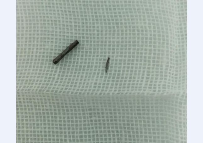 睇到都痛小榄打工仔眼前一闪一厘米长的铁片击中眼球