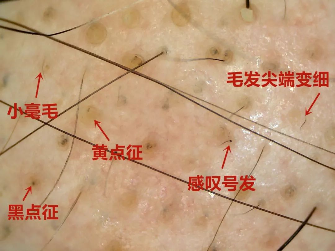 在皮肤镜下,斑秃可表现为黄点征,黑点征,断发,感叹号发,以及毛发尖端
