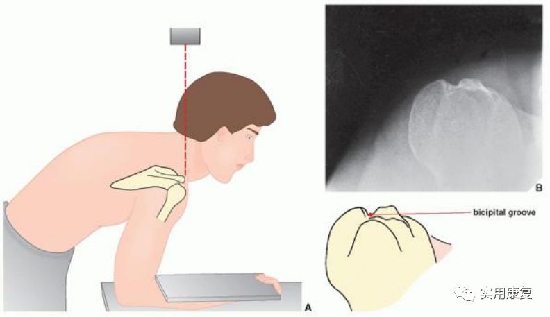 肩关节侧位怎么摆位图片