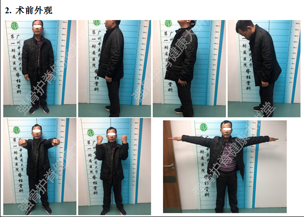 左上肢臂丛牵拉试验( ),左侧椎间孔挤压试验( ),叩顶试验( ),双侧转颈